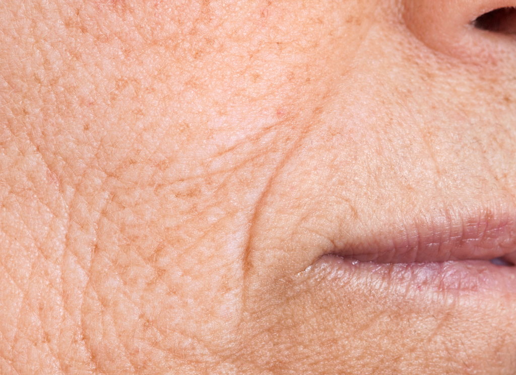 Fillers rimpeltjes
