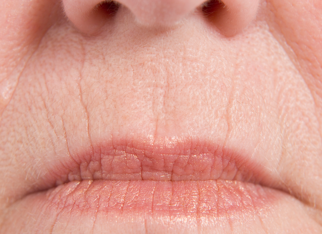 Fillers rimpeltjes