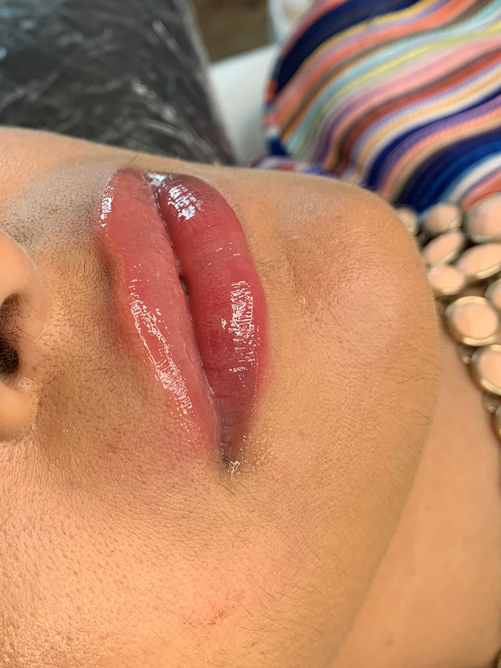 Lipfillers