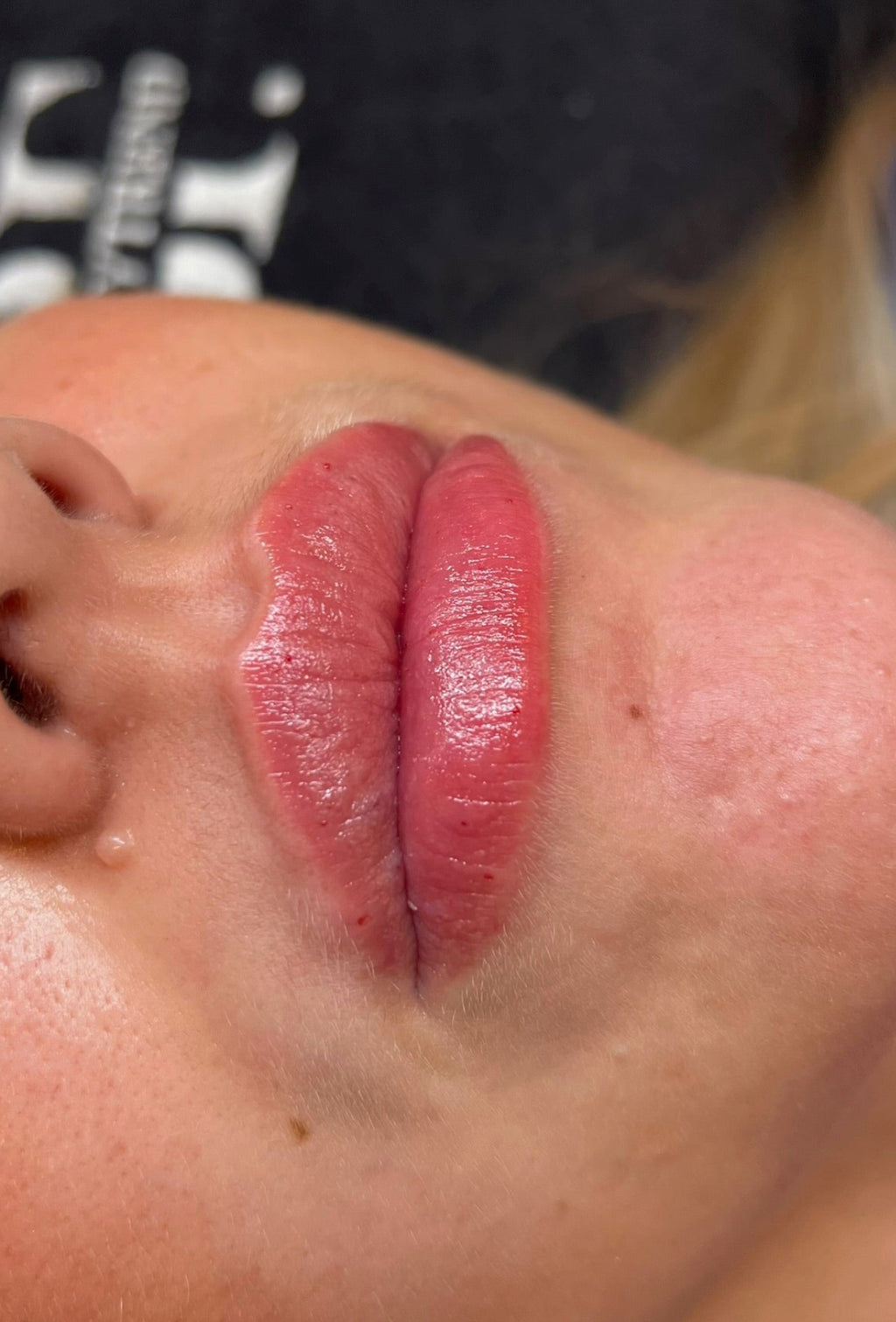 Lipfillers