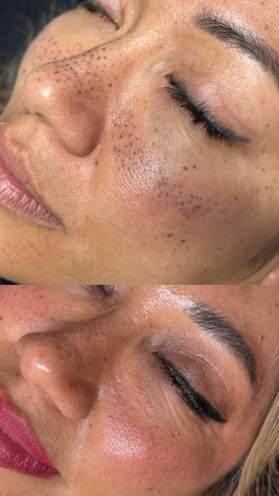 faux freckles removal, nep sproetjes verwijderen, pmu sproetjes laseren verwijderen